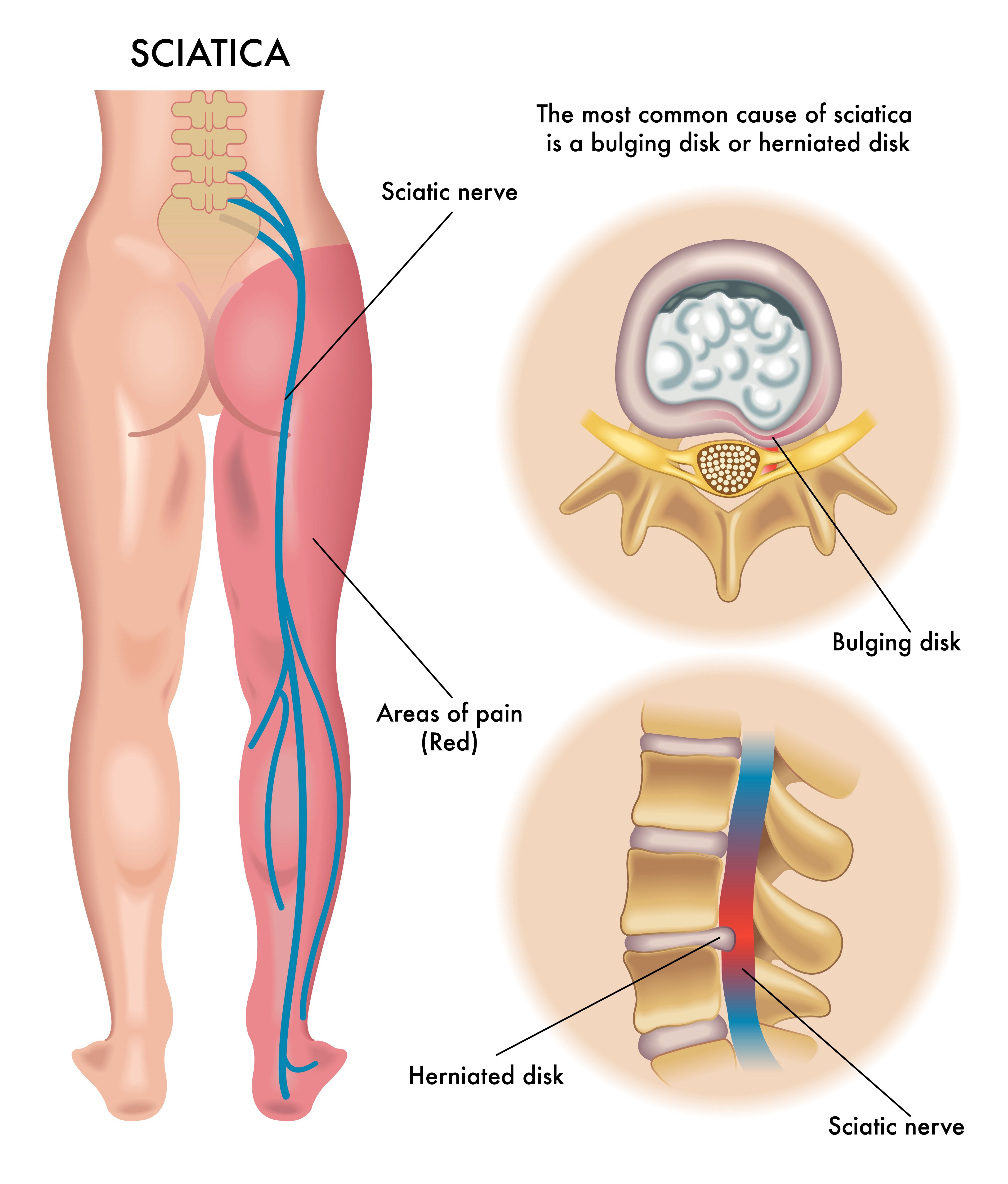 Lumbago, Sciatica and back pain