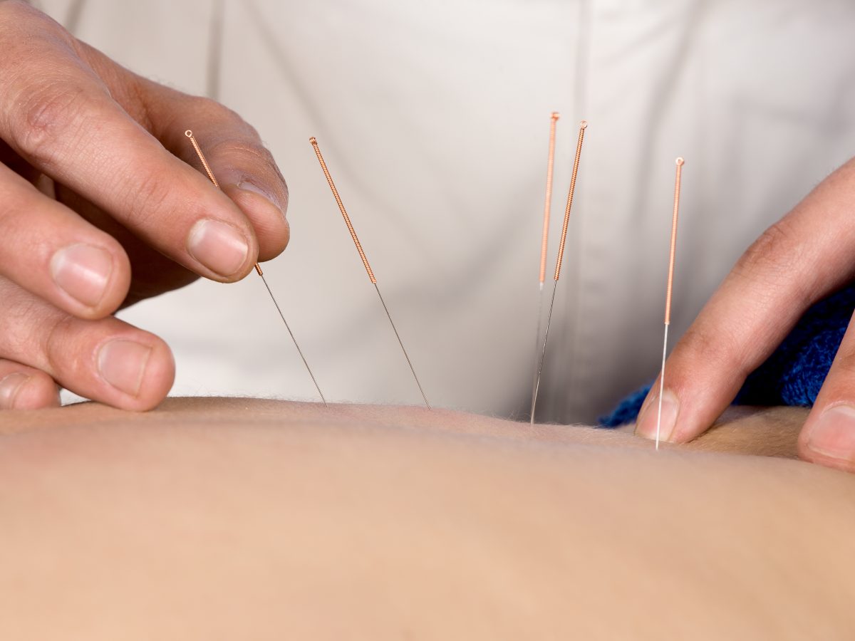 Adult,Male,Physiotherapist,Is,Doing,Acupuncture,On,The,Back,Of