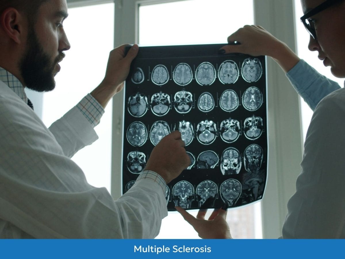 Multiple sclerosis