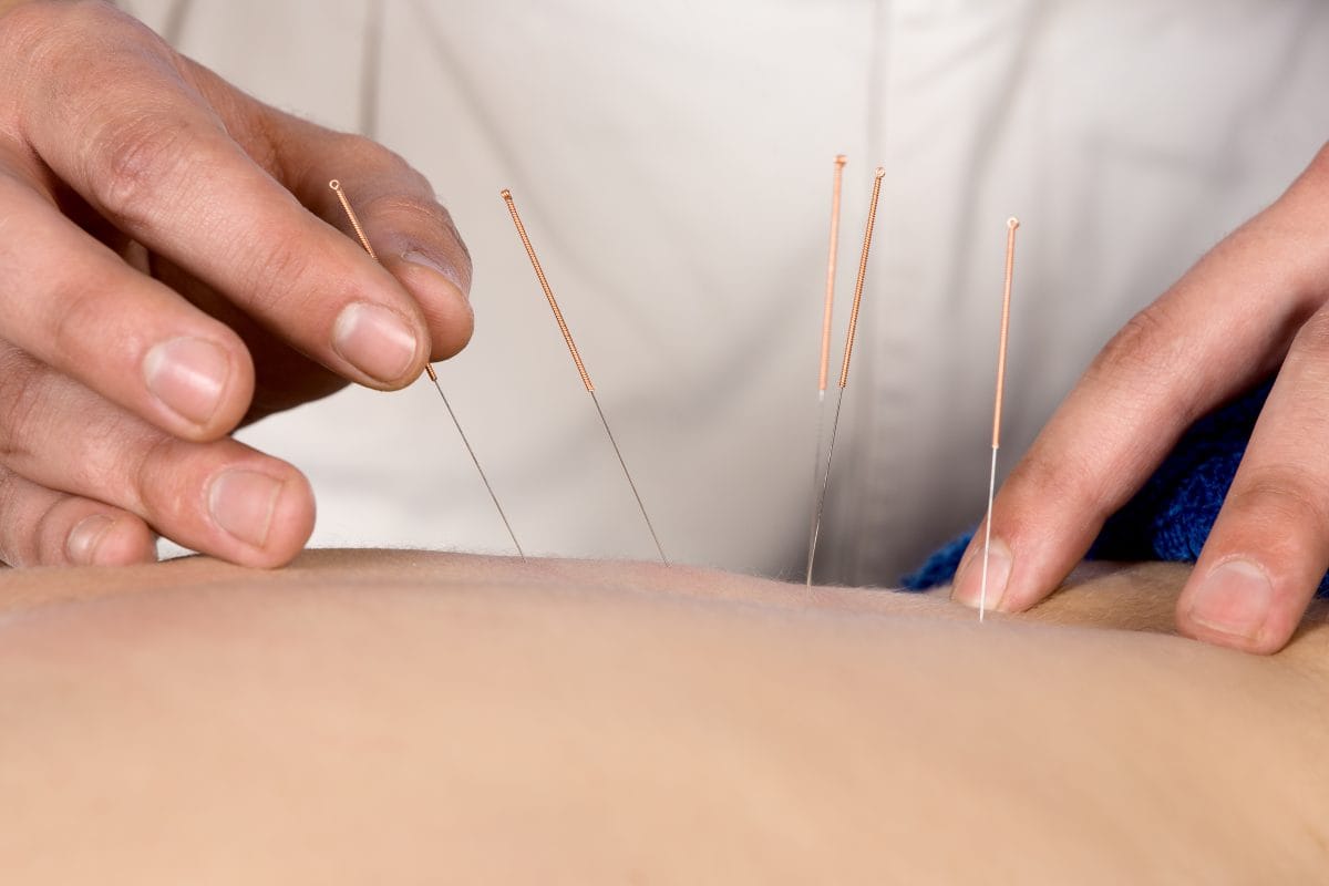 Adult,Male,Physiotherapist,Is,Doing,Acupuncture,On,The,Back,Of